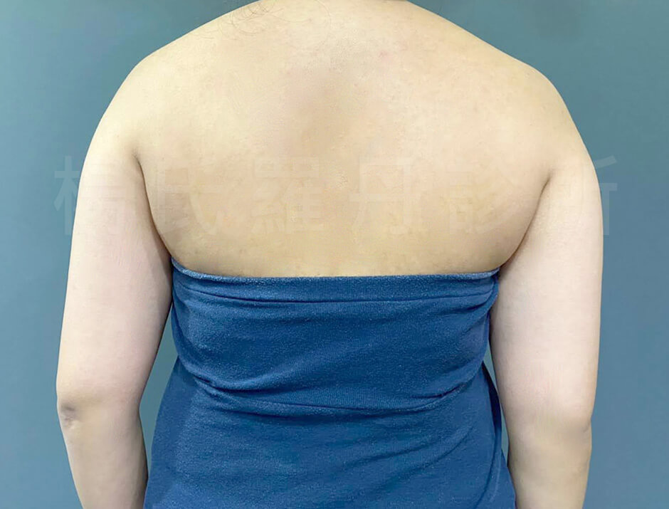 雷射減脂 減脂手術 瘦手臂 手臂